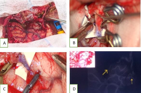 A: Intra op picture showing double barrel STA-MCA anastomosis; B: intra op picture showing M3-parietal branch of STA anastomosis; C: Intra op picture showing temporal cortical-frontal branch of STA anastomosis; D: Intra op ICG showing double barrel STA-MCA anastomosis