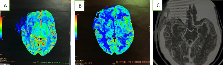 A: CT perfusion study showing good perfusion in right perisylvian region; B: CT perfusion study showing good perfusion in right ganglio capsular region; C: CT perfusion study showing adequate cross flow across the STA to MCA on right side.