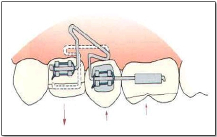 Segmental T-loop in a rectangular wire4