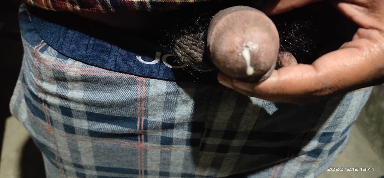 Purulent and copious urethral discharge : Gonococcal urethritis