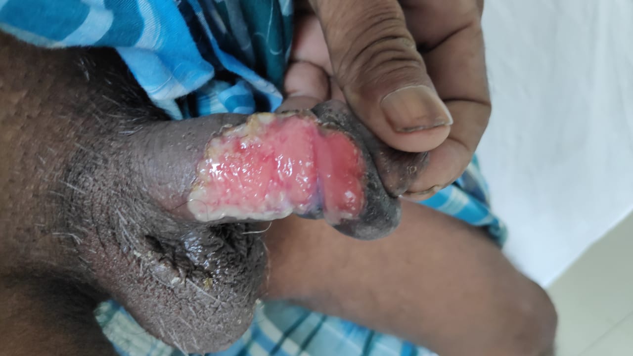 Chancroid ulcer: painful, sharply circumscribed ulcer with ragged and undermined edges