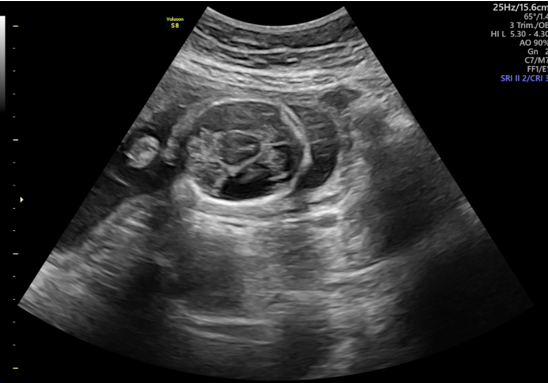 Ultrasound of the fetal head shows accumulation of fluid in the cranial cavity.