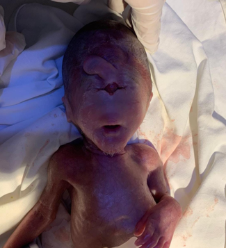 Thefetus after birth appears to have only one eye and has a proboscis in the frontal.