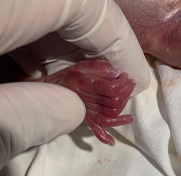Polydactyly is seen on the fingers.