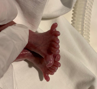 Polydactyly is seen on thetoes.