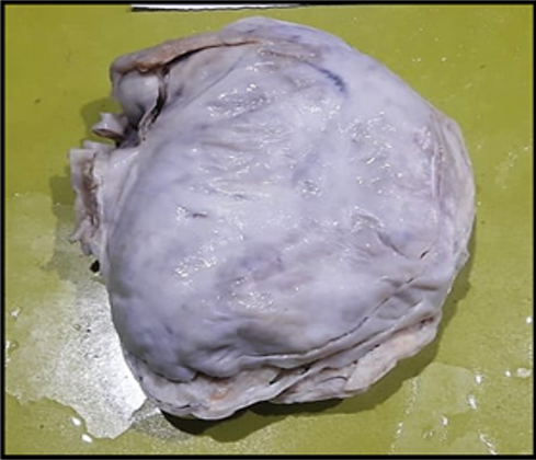Gross external surface: Large globular smooth glistening mass measuring 12X9X3cm