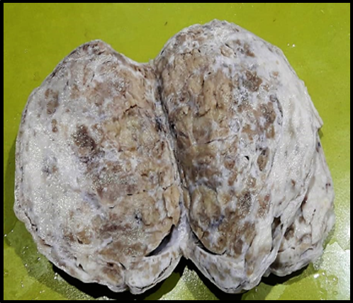 Gross cut section: variegated appearance. Predominantly solid with tiny cysts