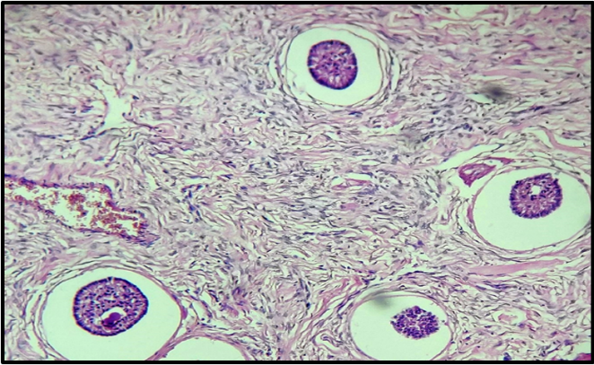 Microphotograph 100X magnification H&E stain: sertoli cell & granulosa cell differentiation, hyalinised stroma