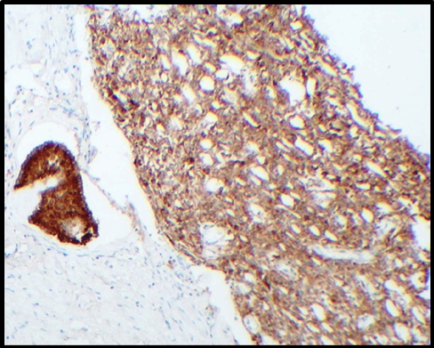 Microphotograph: 40X magnification: tubules showing immunopositivity for Alpha Inhibin