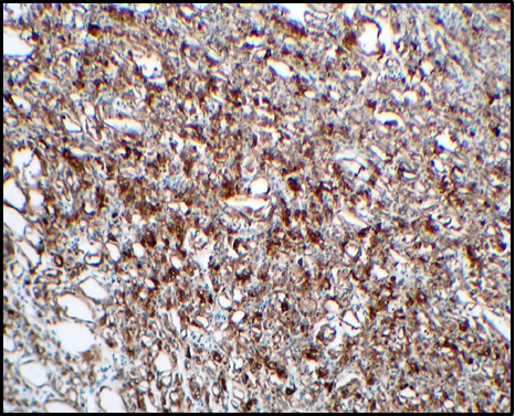 Microphotograph 40X magnification: Tubules showing diffuse immunopositivity for Pancytokeratin