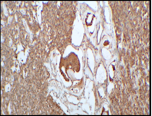 Microphotograph 40X magnification: Tubules showing diffuse immunopositivity for calretinin