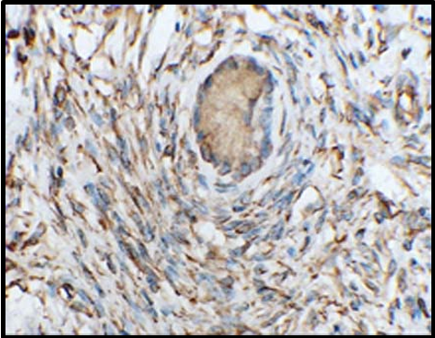 Microphotograph 400X magnification: Immunoreactivity for vimentin. The stromal cells and tubules with sertoli cell differentiation show positivity
