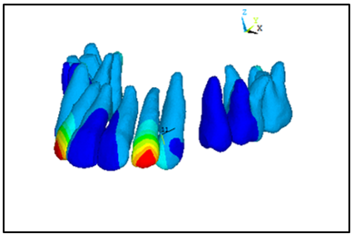 Geometric model without first premolars.