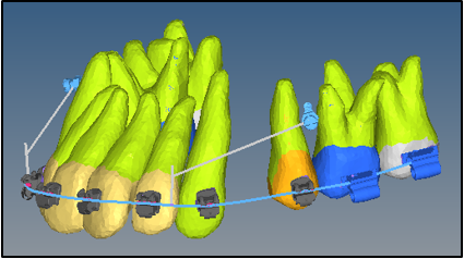 Mini implant arrangement