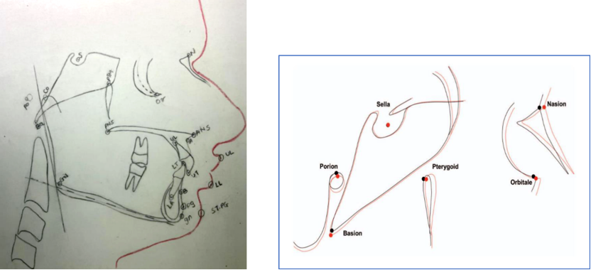 Cephalometric landmark used in hand and digital tracing -Anterior nasal spine (ANS), Posterior nasal spine (PNS), Point. A, Gnathion(gn), Pogonion (pg), Point B, U1 tip, U1 apex, L1 tip, L1 apex, ST Pg, ST Lower lip, ST Upper lip.