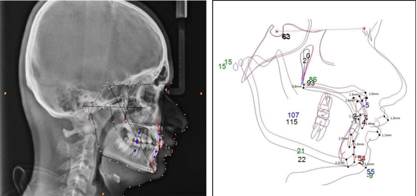 Dolphin software used for digital tracing and superimposition.