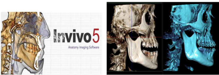 Software used for 3-D superimposition Invivo5 - Reference points for digita tracing: (sella, Nasion, Porion, orbitale , pterygoid ,basion).