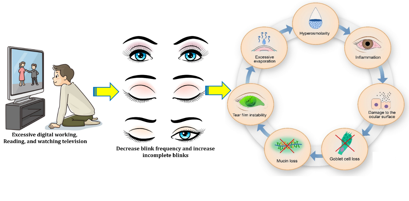 Etiological factors in the pathogenesis of dry eye disorder12