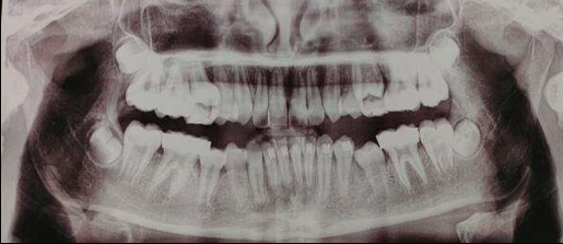 Post-orthopedic OPG