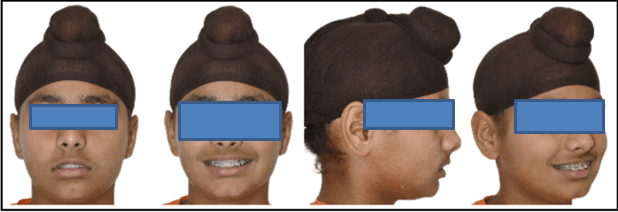 Extraoral photographs after relapse