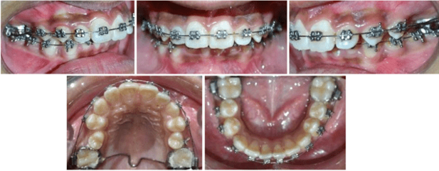 Intraoral photographs after relapse