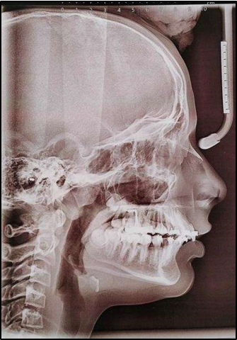 Lateral cephalogram after relapse