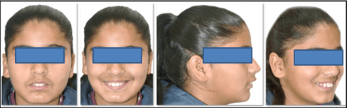 Pretreatment extraoral photographs