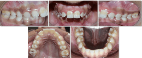Pretreatment intraoral photographs