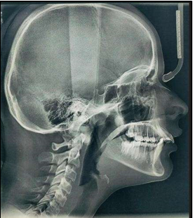 Pretreatment lateral cephalogram