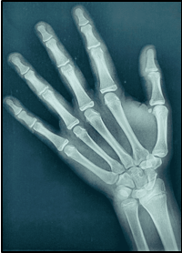 Pretreatment hand wrist radiograph