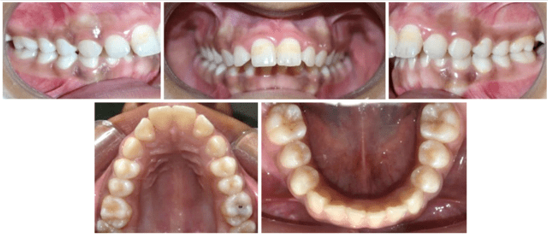 Post orthopedic intraoral photographs