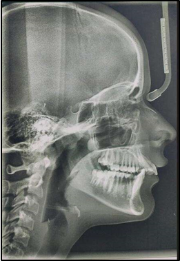 Post orthopedic lateral cephalogram