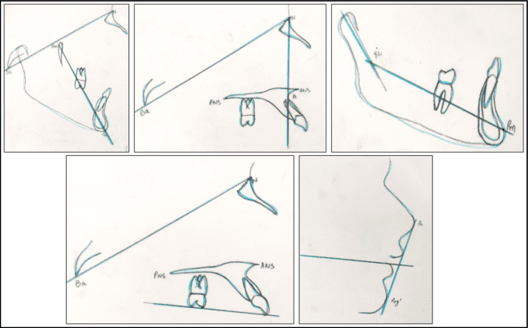 Superimposition Case 2Pretreatment cephalometric tracing Superimposition after relapse