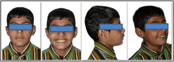 Pretreatment extraoral photographs