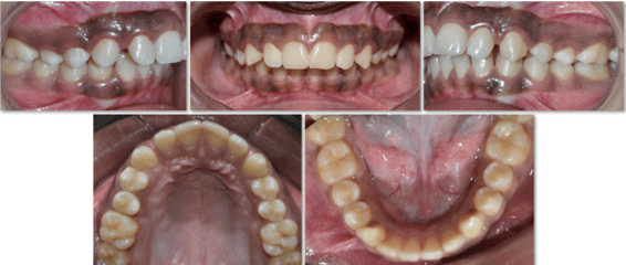 Pretreatment intraoral photographs