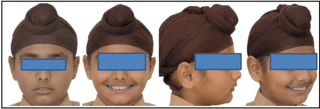 Pretreatment extraoral photographs