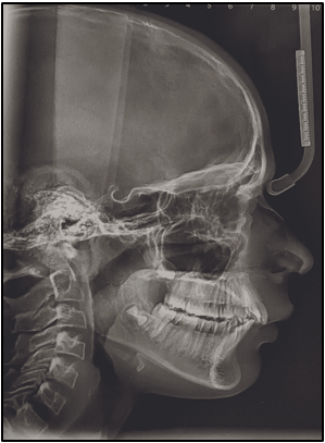 Pretreatment lateral cephalogram