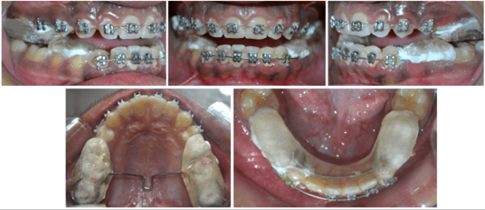 Twin block appliance alongwith fixed mechanotherapy