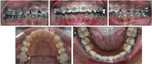 Post orthopedic intraoral photographs