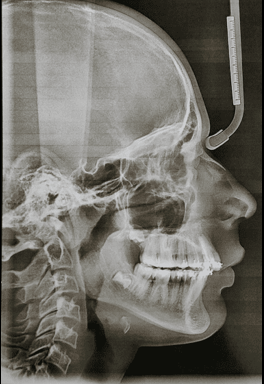 Post orthopedic lateral cephalogram