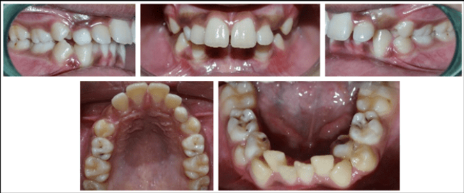 Pretreatment intraoral photographs