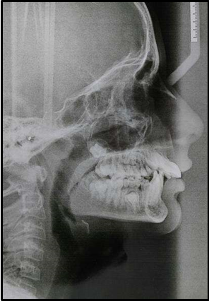 Pretreatment lateral cephalogram