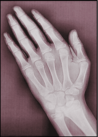 Pretreatment hand wrist radiograph