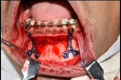 “Y” shaped miniplate fixation in the lower anterior region for the engagement of functional appliances