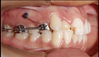 TADS supported Molar distalization