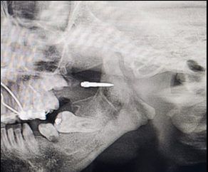 Miniscrew inserted in the anterior ramus for molar up righting