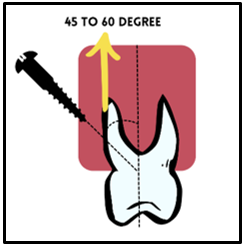 Angulation of miniscrew in maxillary posterior region