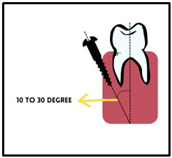 Angulation of miniscrew in mandibular posterior region
