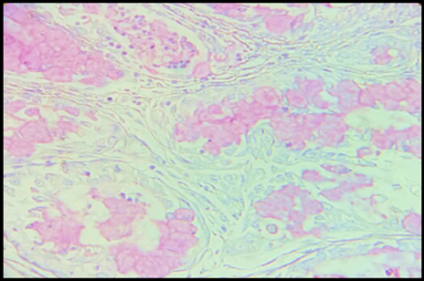 Mucoepidermoid Carcinoma: Microphotograph showing mucicarmine positivity (MC 10x)