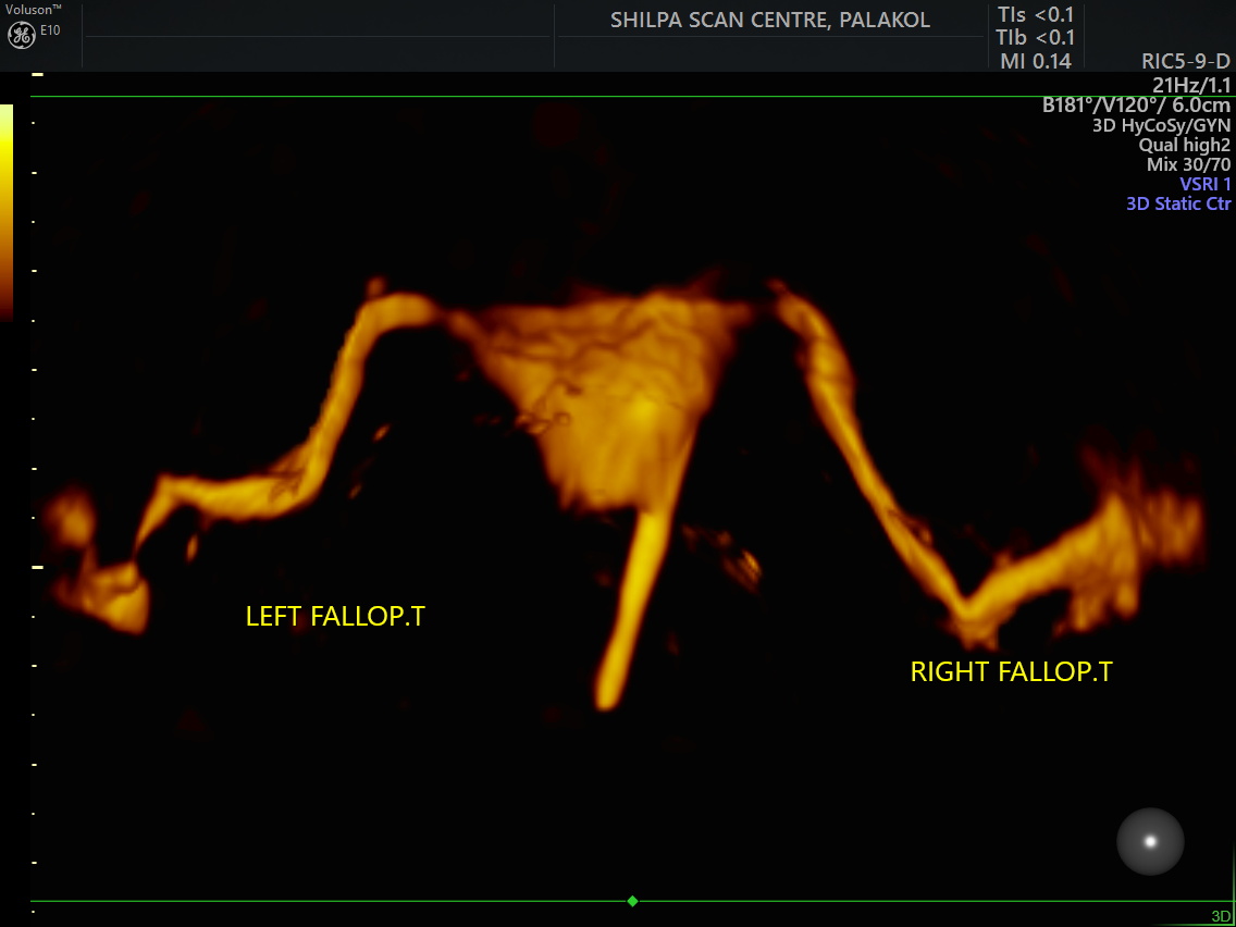 3D HyCoSy displaying unobstructed patency of both right and left tubes